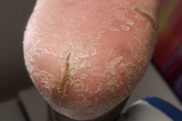 Ferse mit flächiger, schuppiger Hornhaut und einer tiefen Schrunde, in der eingetrocknetes Blut sichtbar ist.