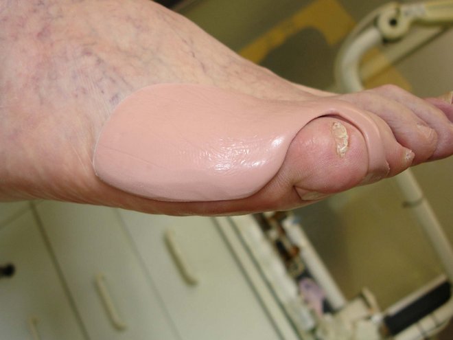 Zehen-Orthese aus Silikon am Vorfuss, die die Grosszehe von der zweiten Zehe separiert